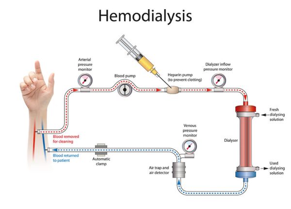 Illustration of hemodialysis